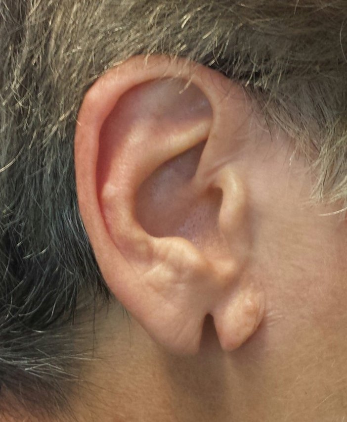 Lobul urechii despicat preoperator