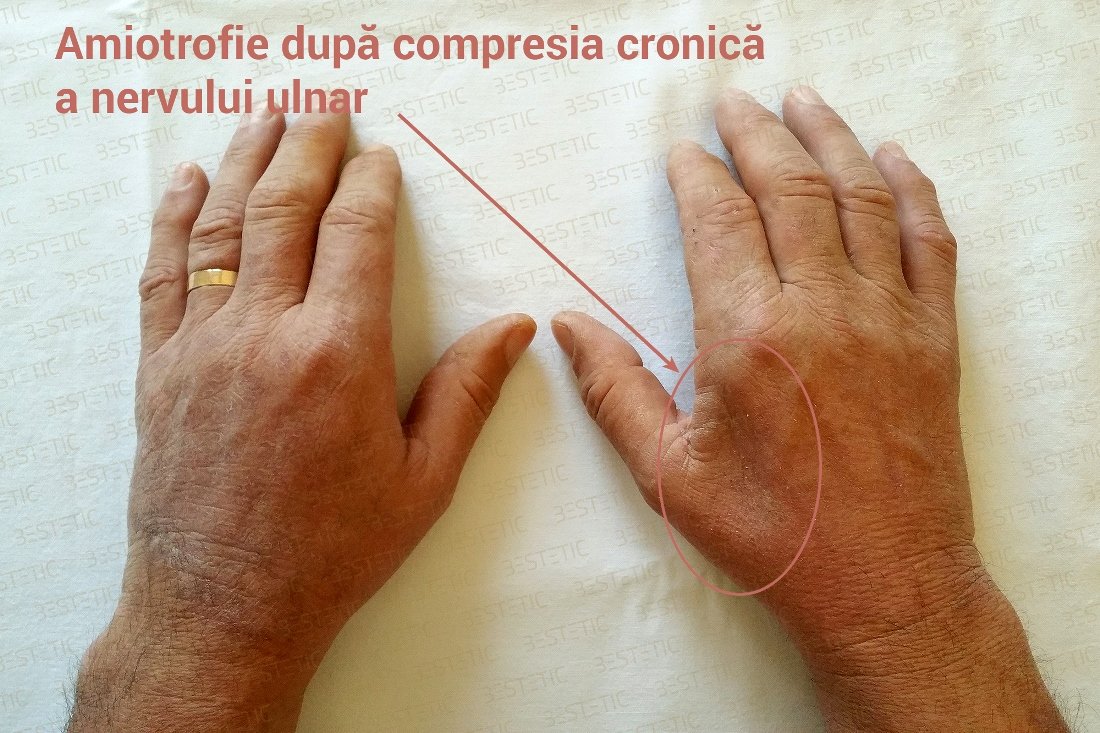 degetele maini amortite artroza tratamentului medicamentos pentru articulațiile umărului