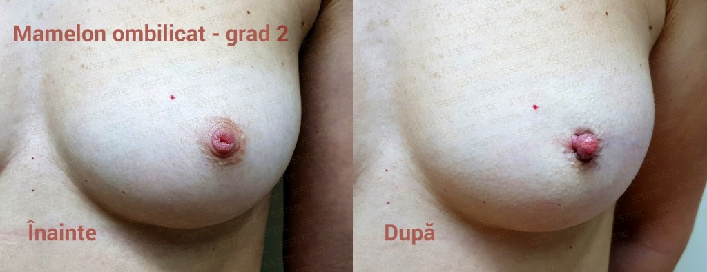 Mamelon ombilicat