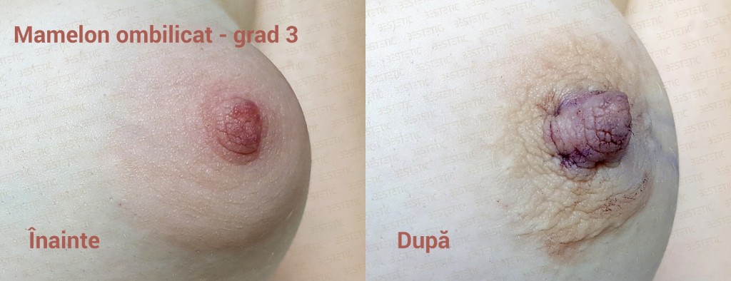 Mamelon ombilicat