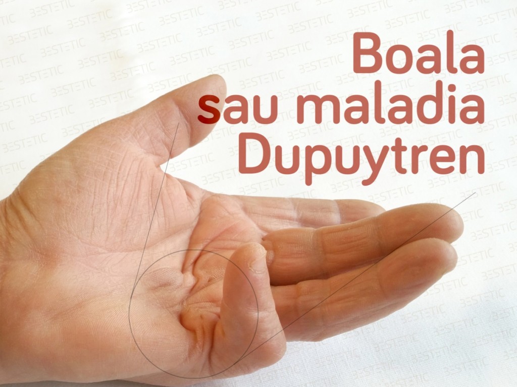 Xiapex fara operatie in Boala Dupuytren