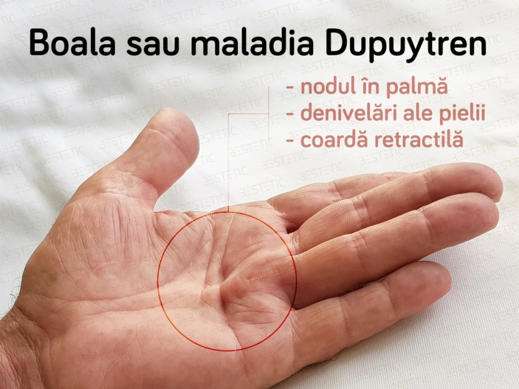 Xiapex fara operatie in Maladia Dupuytren