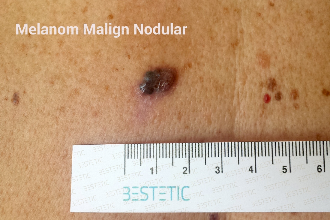 ce marker tumoral pentru melanom suspectat