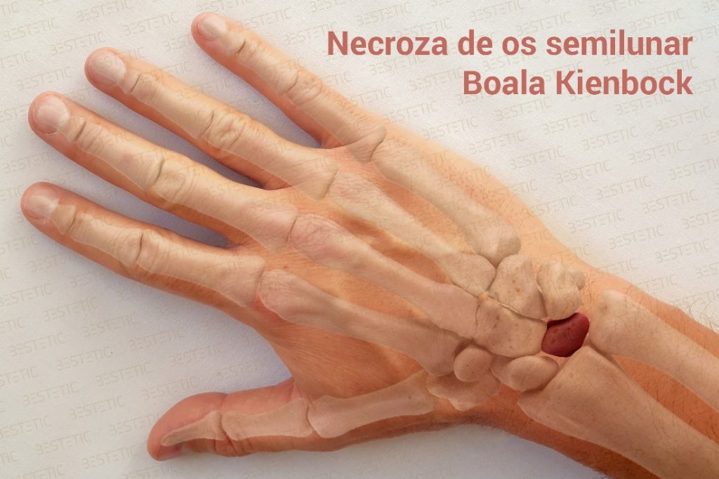 Boala Kienbock disease