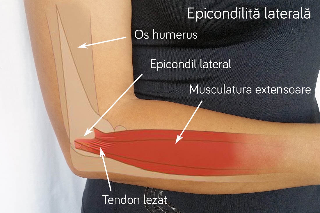 Tratamentul eficient al epicondilitei articulației cotului