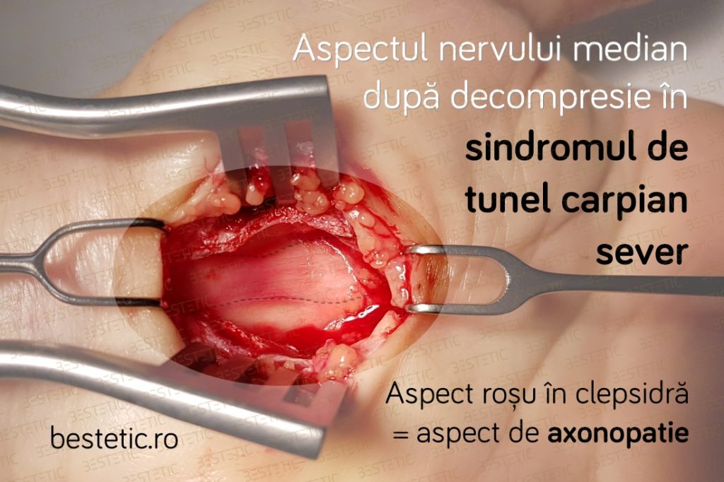 Operatie tunel carpian nerv median cu axonopatie