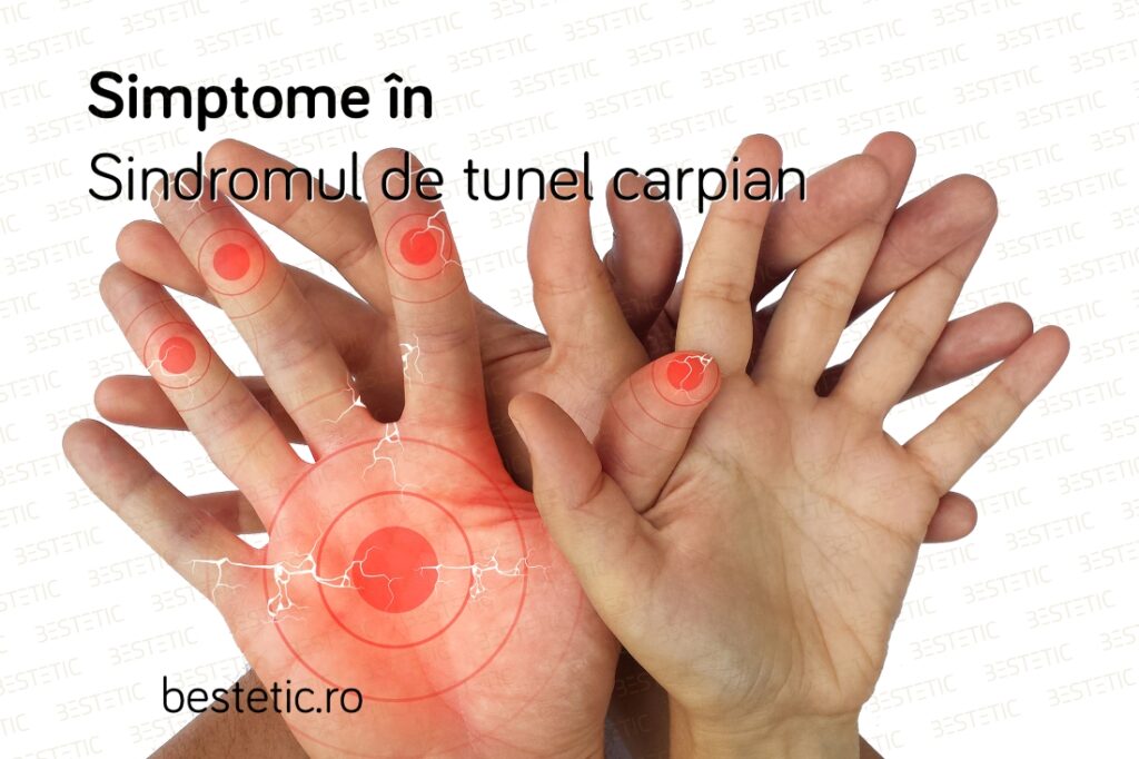 Simptome sindrom de tunel carpian