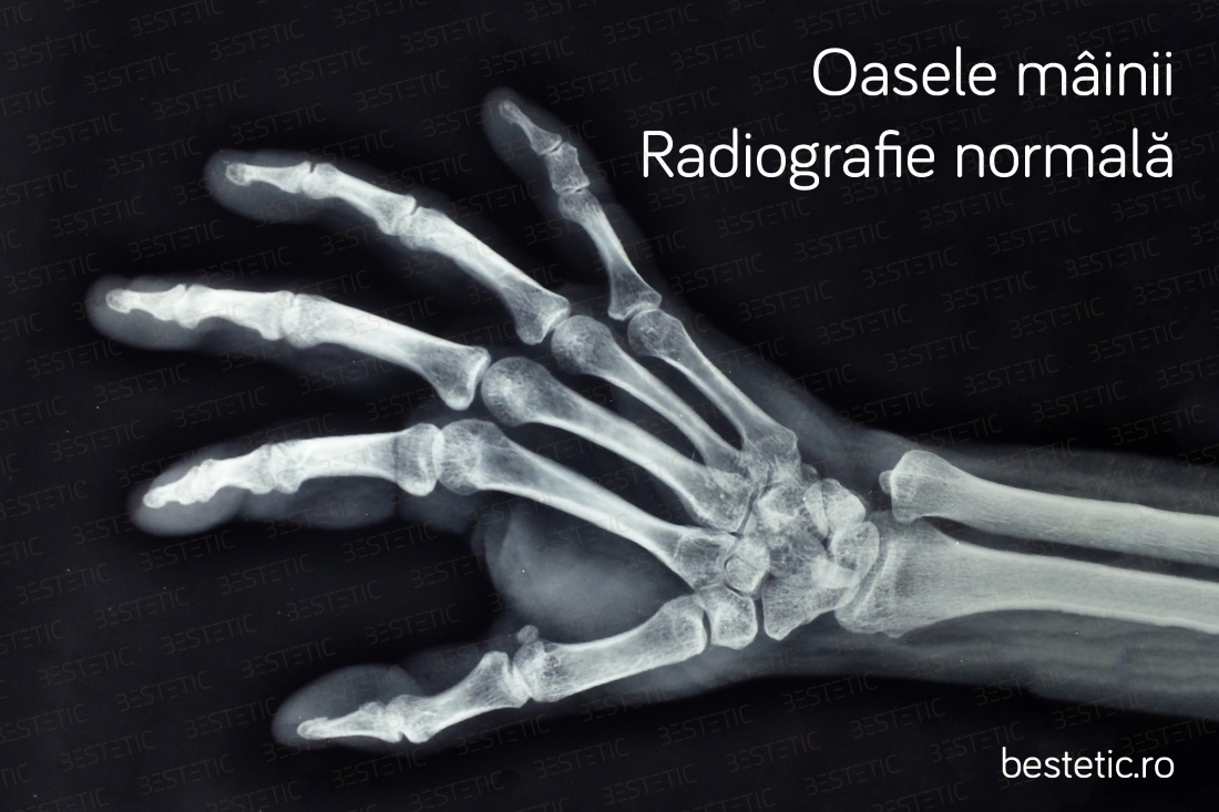 osteoartrita degetelor de gradul II)