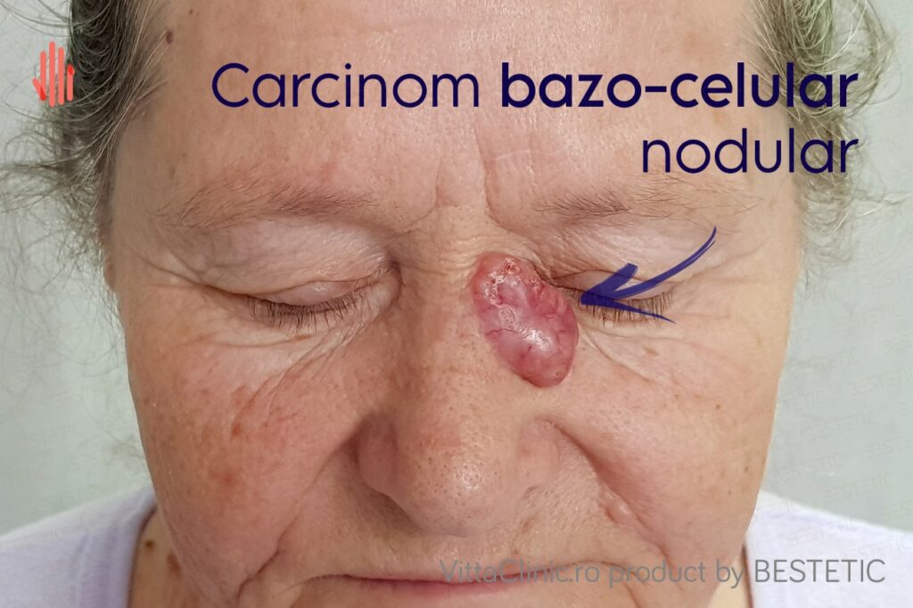 Carcinom Bazo-celular la nas