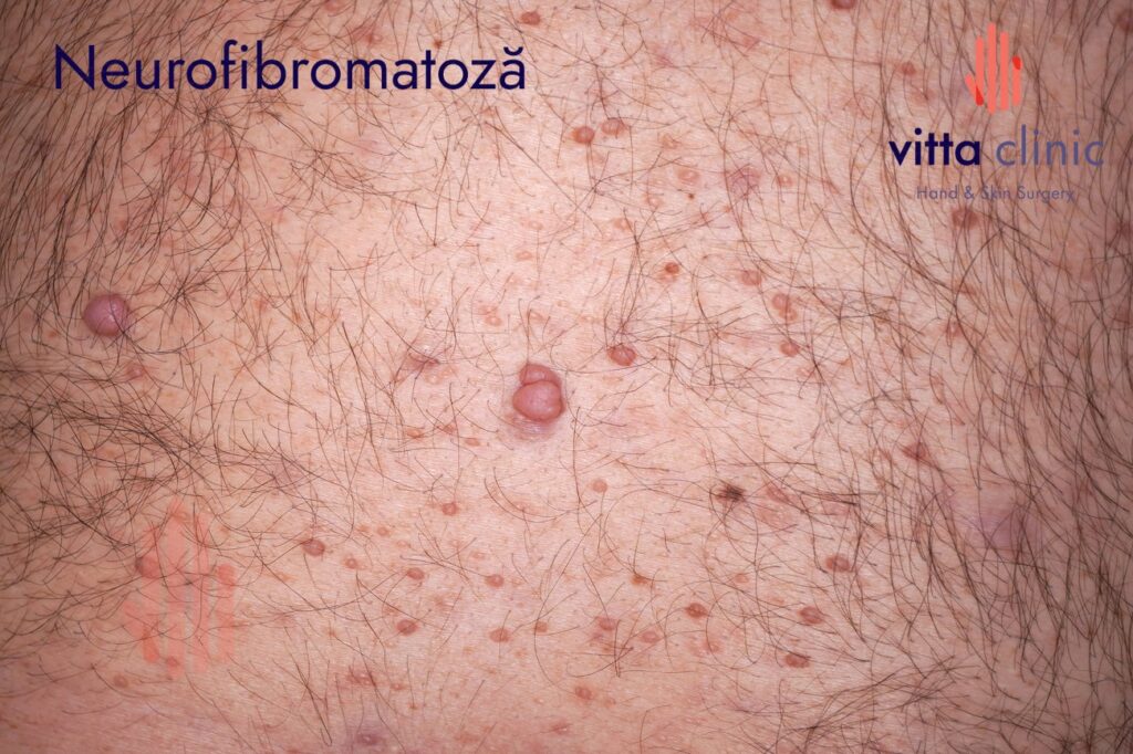 Neurofibromul și neurofibromatoza