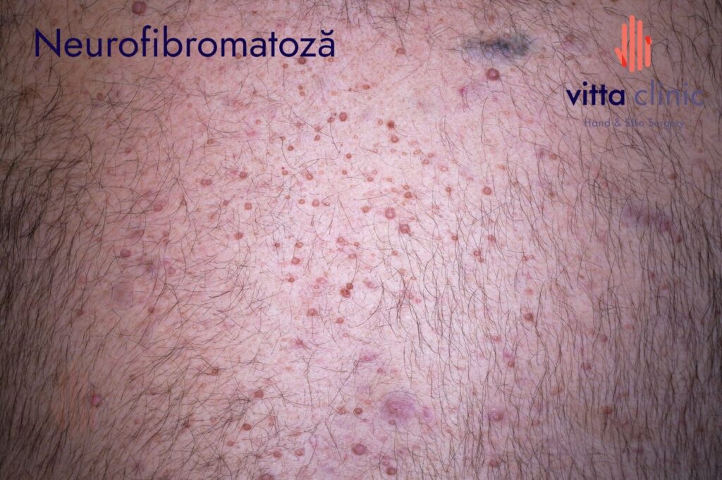 Neurofibromatoză