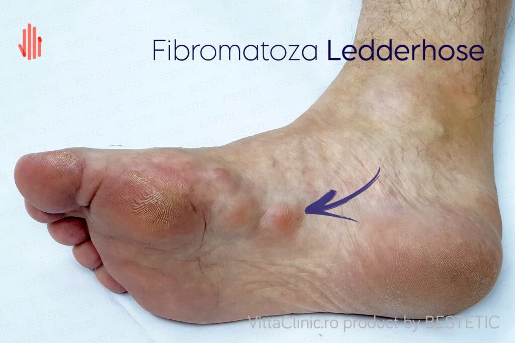 Maladia Ledderhose sau fibromatoza plantara