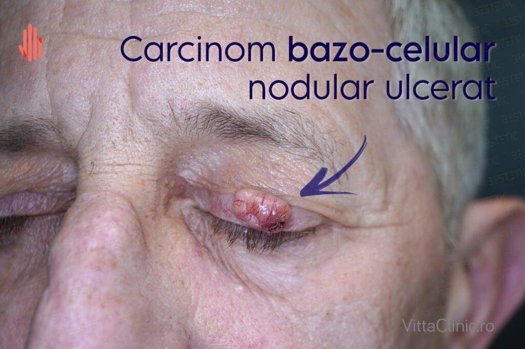 CBC Carcinom bazo-celular la pleoapa