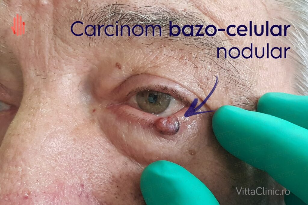 Carcinom bazo-celular la pleoapă
