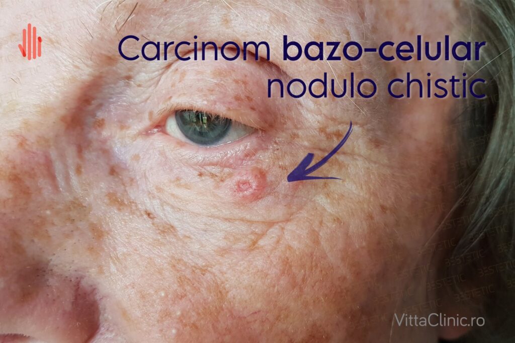 1 CBC Carcinom bazocelular la pleoapa