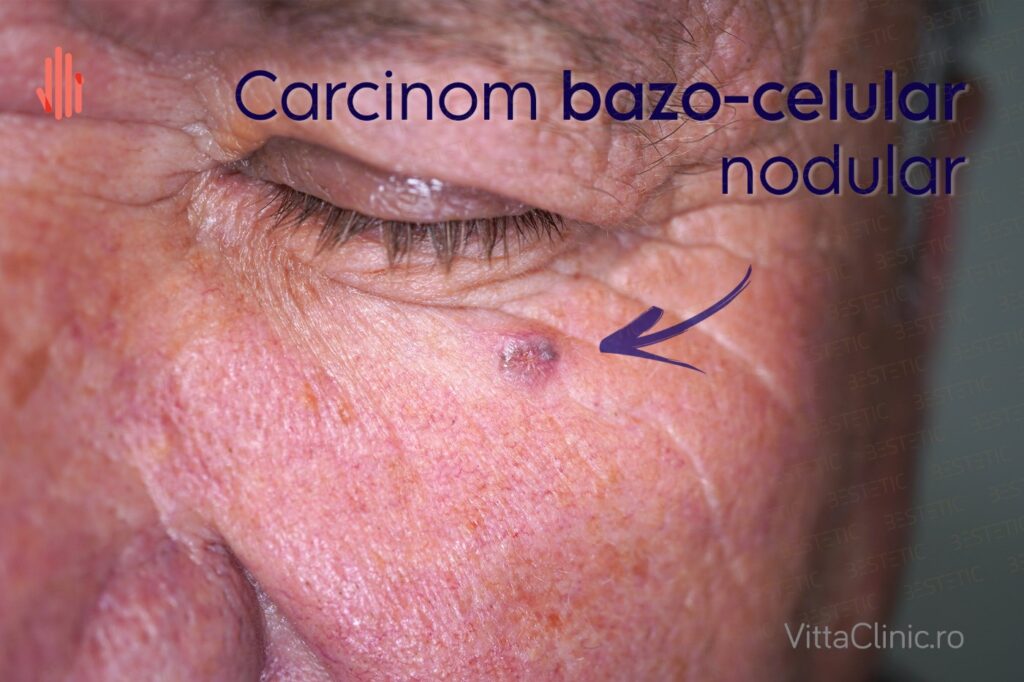 4 CBC la pleoapa Carcinom bazocelular nodular