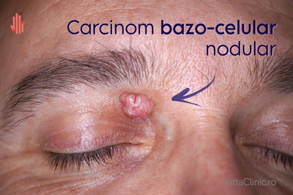CBC ochi fata pleoapa Carcinom bazocelular