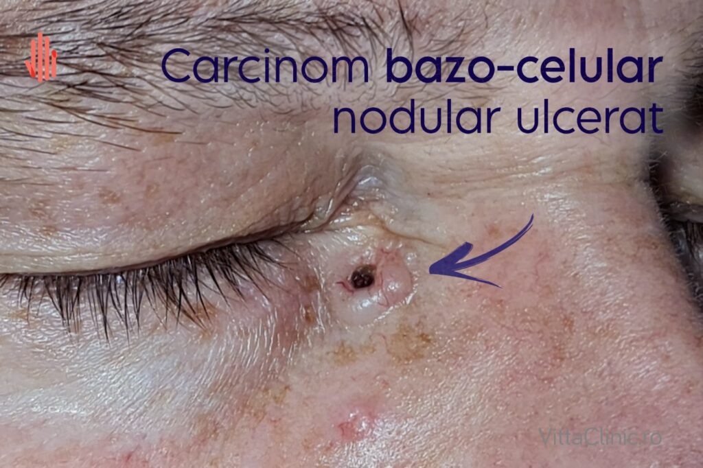 Carcinom bazocelular nodular ulcerat