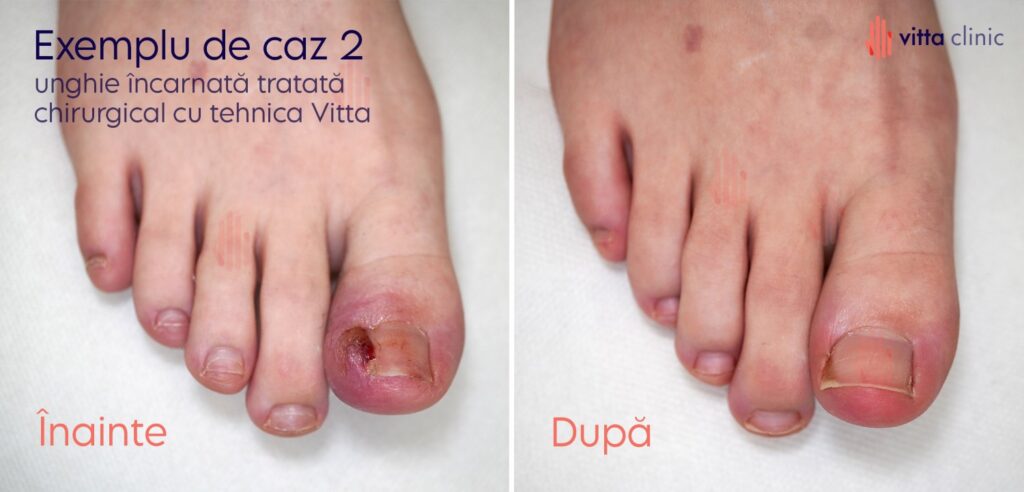 Tratament unghie incarnata cu granulom inainte si dupa Vitta Clinic