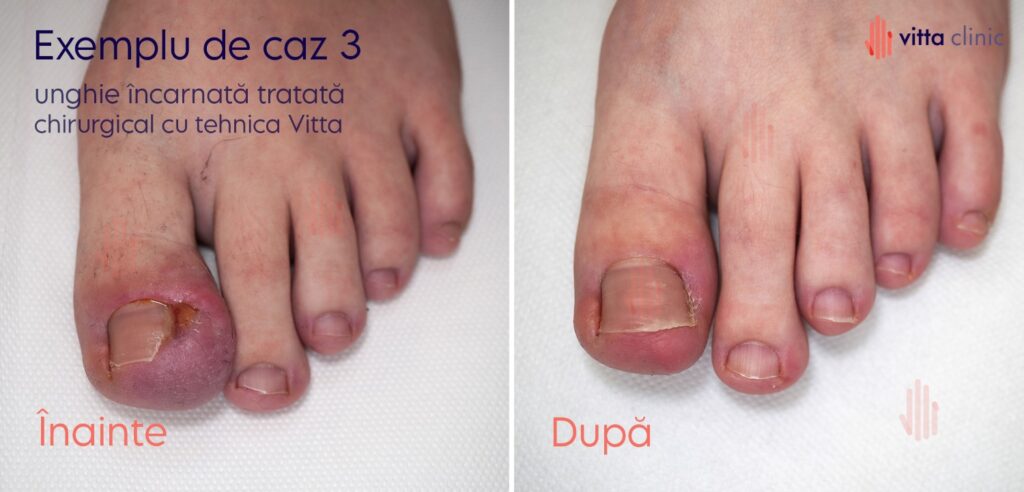 Reconstructie estetica si operatie unghie incarnata Vitta Clinic