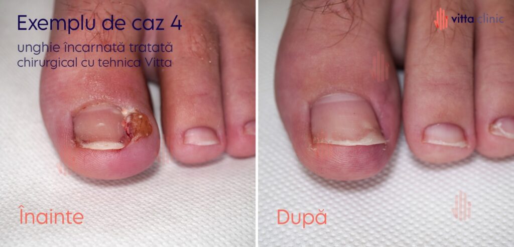 Tratament unghie incarnata fara smulgere inainte si dupa Vitta Clinic