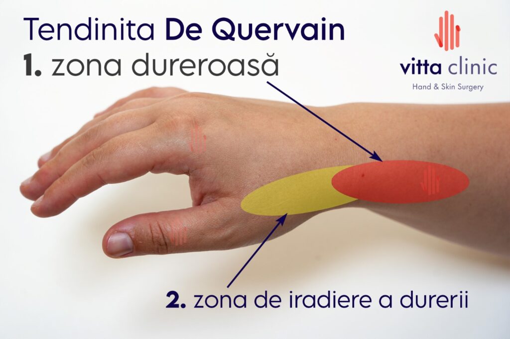 Simptomele tenosinovitei De Quervain: 1. Zona de durere focală (roșu) la baza degetului mare și 2. Zona de iradiere a durerii (galben) în lungul antebrațului.